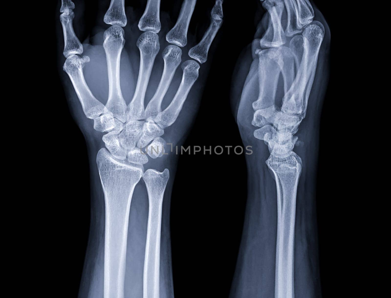 X-ray image of wrist joint for diagnosis rheumatoid arthritis .