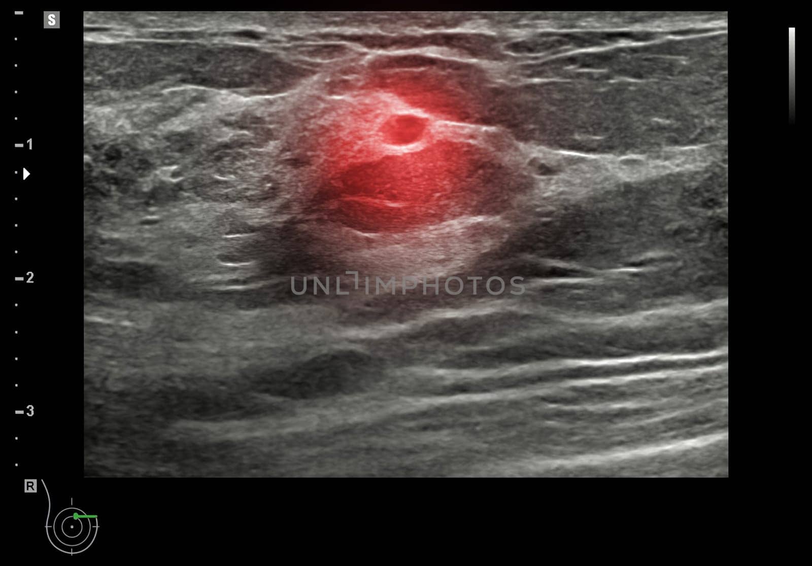 ultrasound breast of Patient after mammogram for diagnonsis Breast cancer in women isolated on black background.