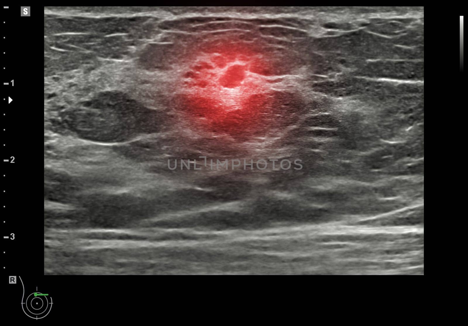 ultrasound breast of Patient after mammogram for diagnonsis Breast cancer in women isolated on black background. by samunella