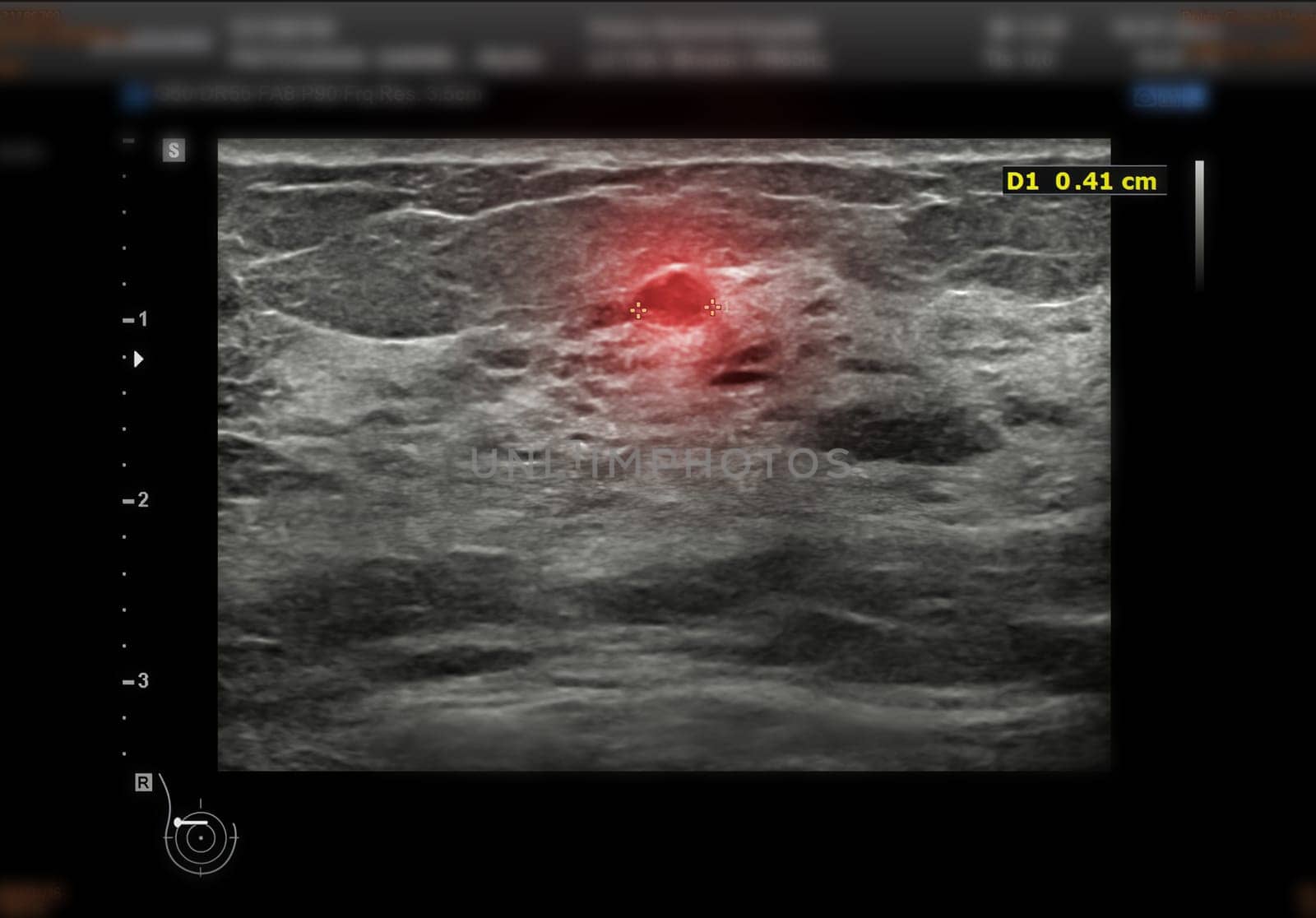 ultrasound breast of Patient after mammogram for diagnonsis Breast cancer in women isolated on black background.