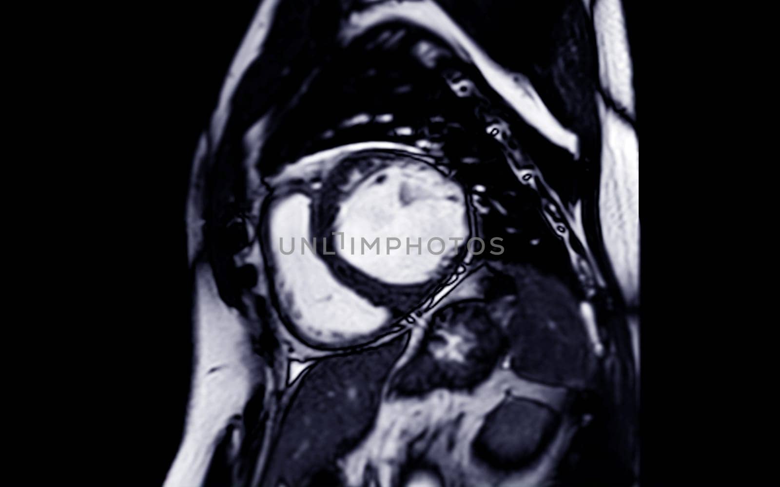 MRI heart or Cardiac MRI in short axis view showing cross-sections of the left and right ventricle for diagnosis heart disease. by samunella