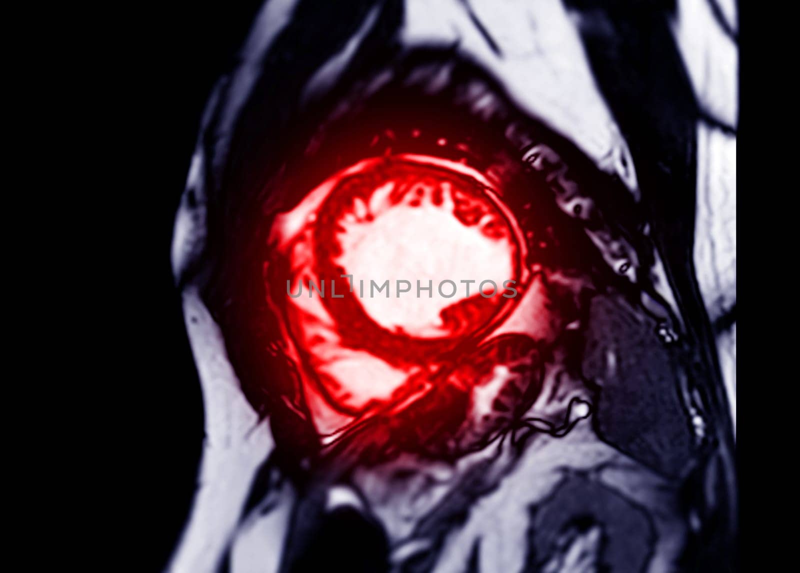 MRI heart or Cardiac MRI in short axis view showing cross-sections of the left and right ventricle for diagnosis heart disease.