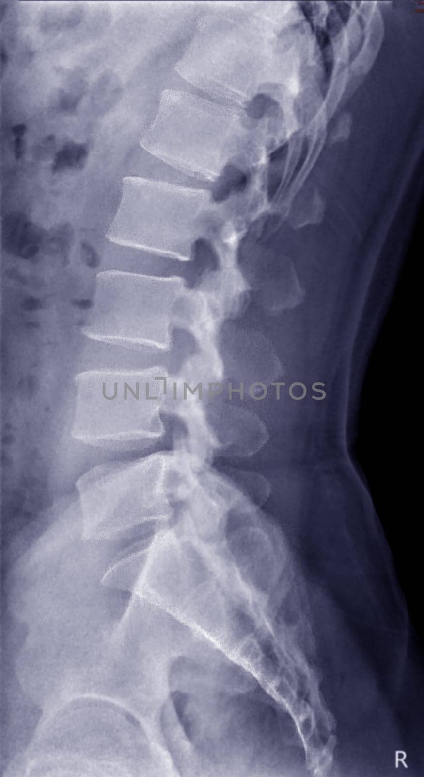 X-ray image of lambosacral spine or L-S spine by samunella