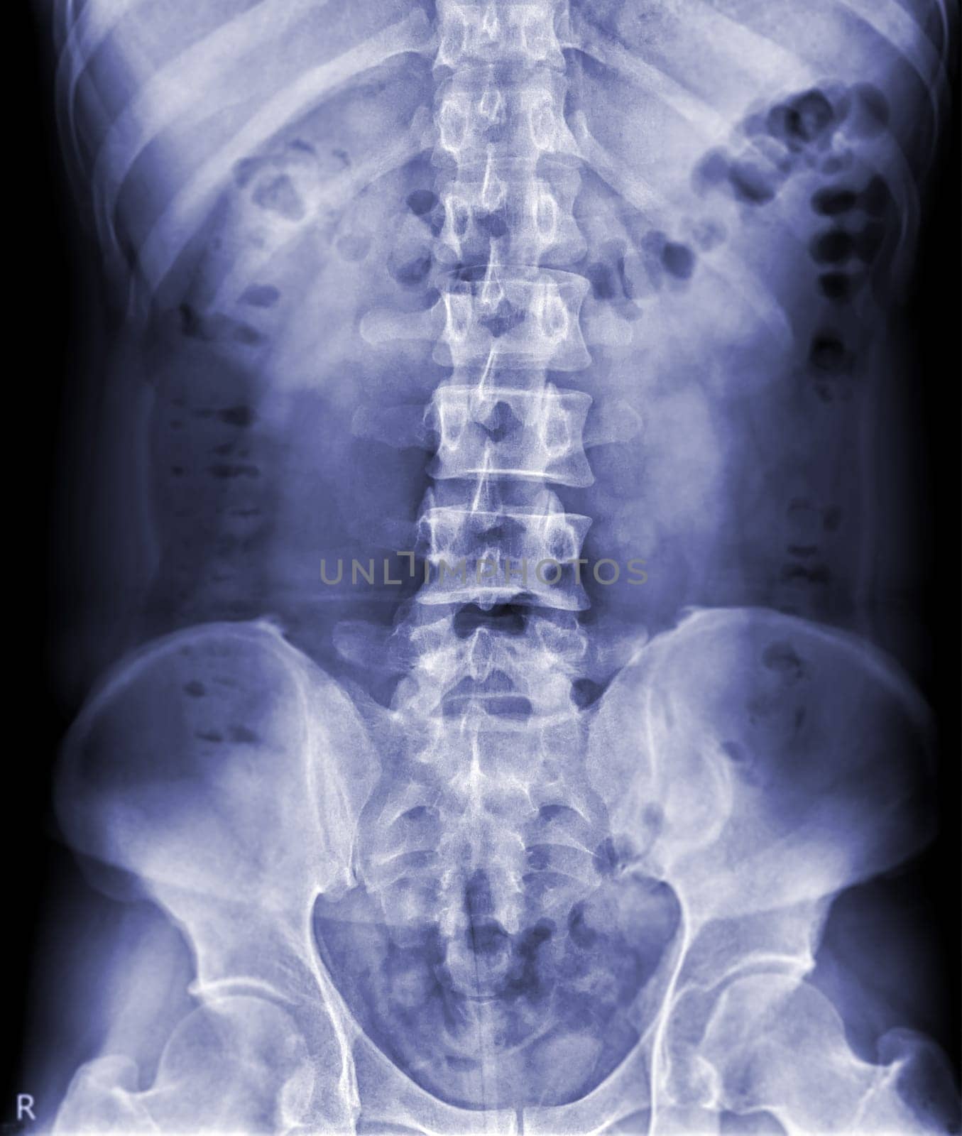 X-ray image of lambosacral spine or L-S spine by samunella