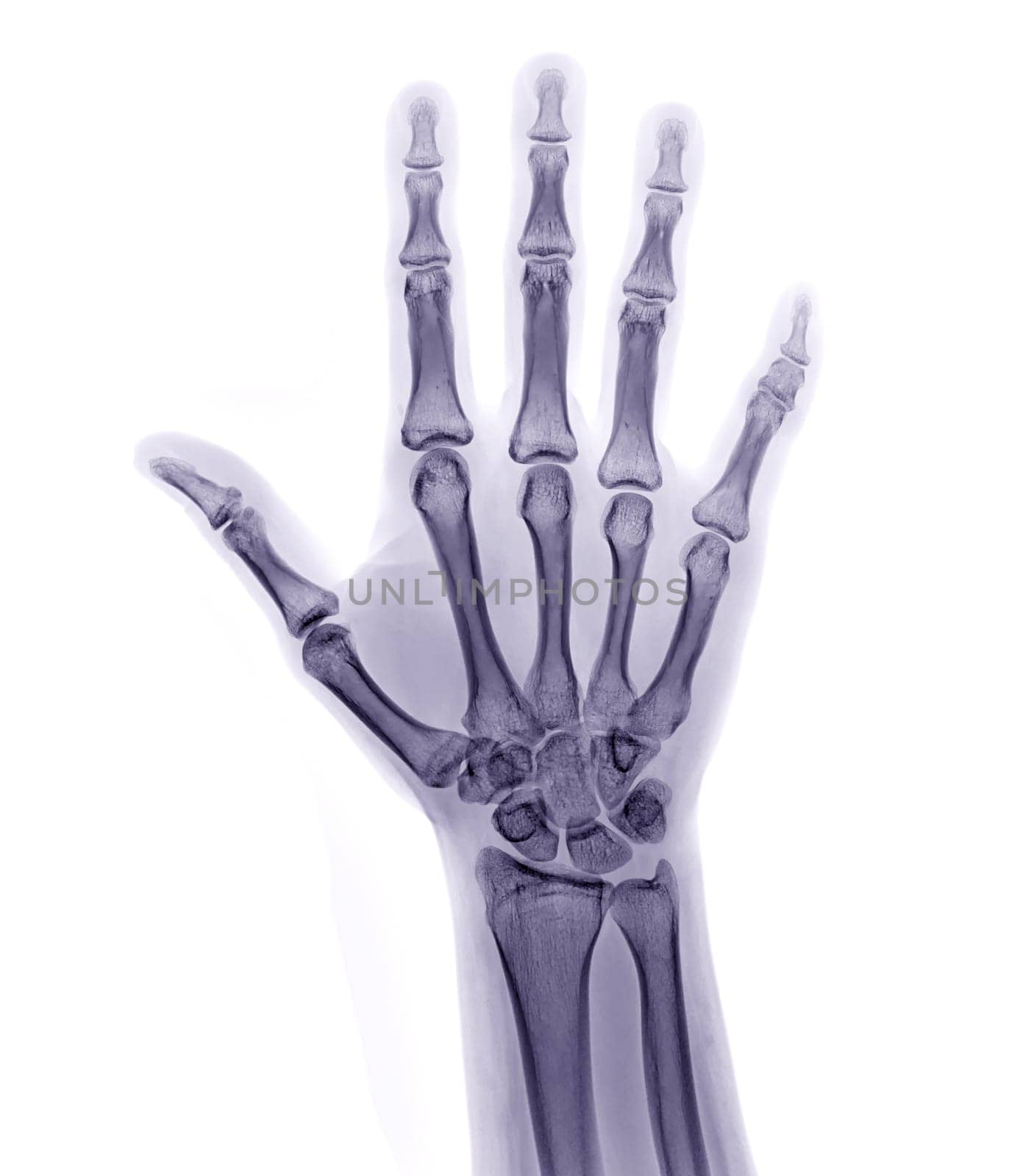 xray image of both hand AP view isolated on white background for diagnostic rheumatoid.