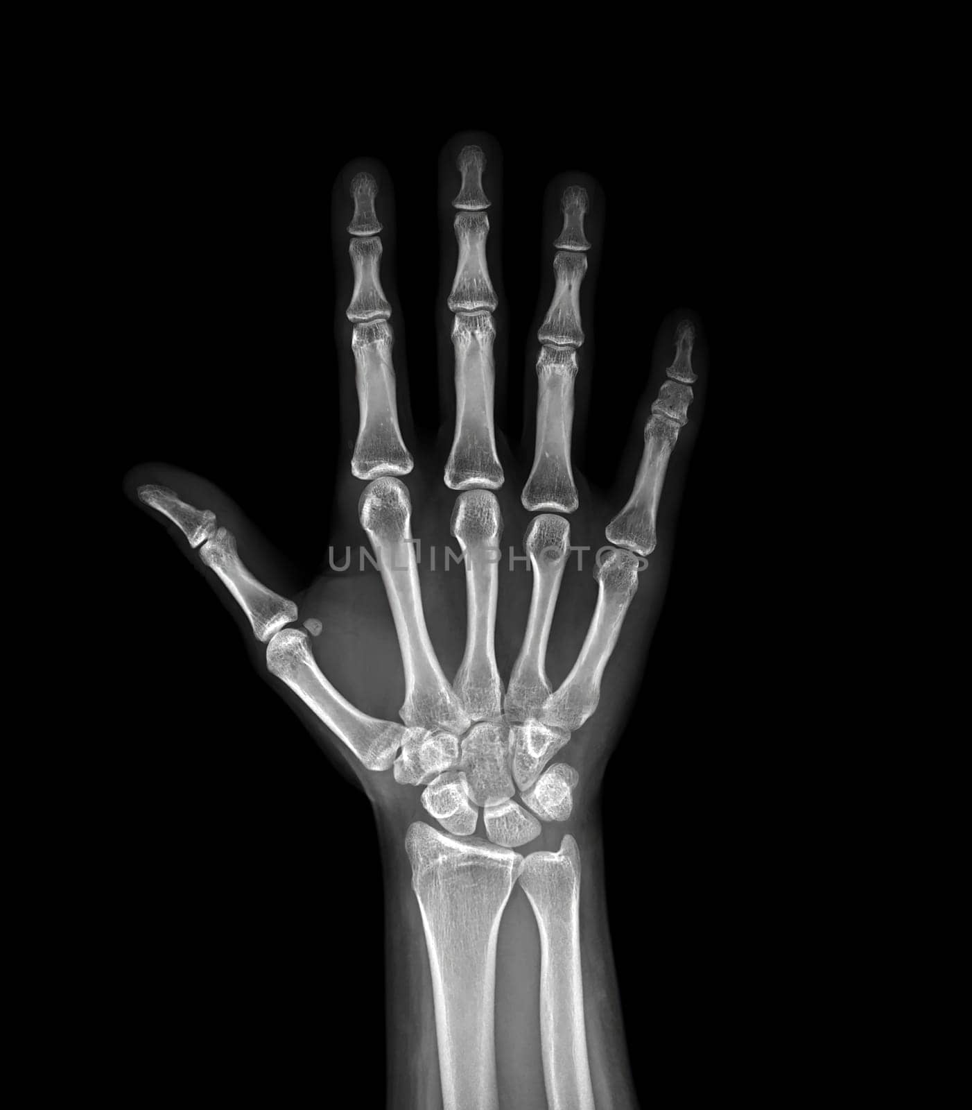 xray image of both hand AP view isolated on black background for diagnostic rheumatoid.