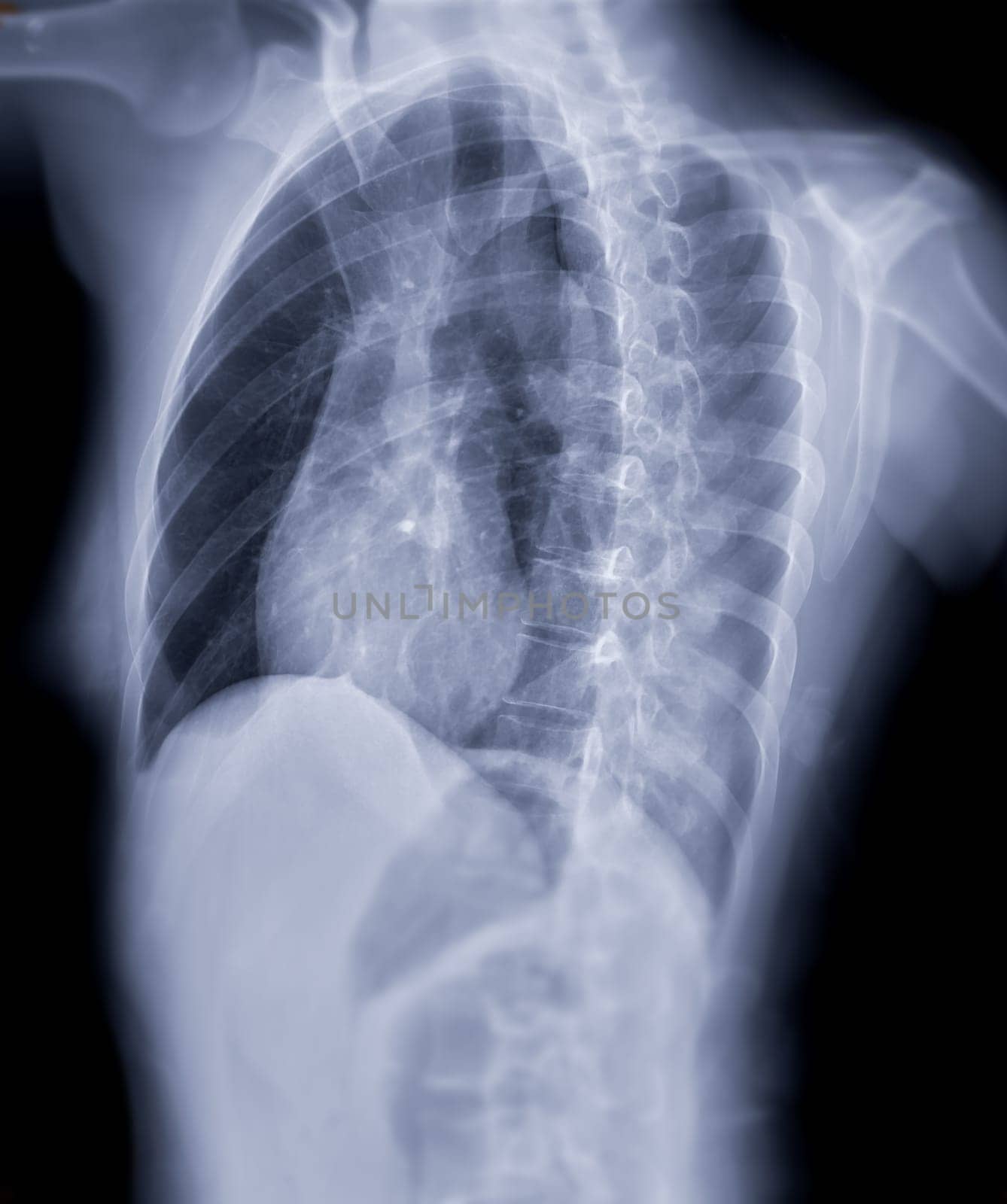 Chest x-ray image oblique view for screening diagnosis TB,tuberculosis and covid-19.