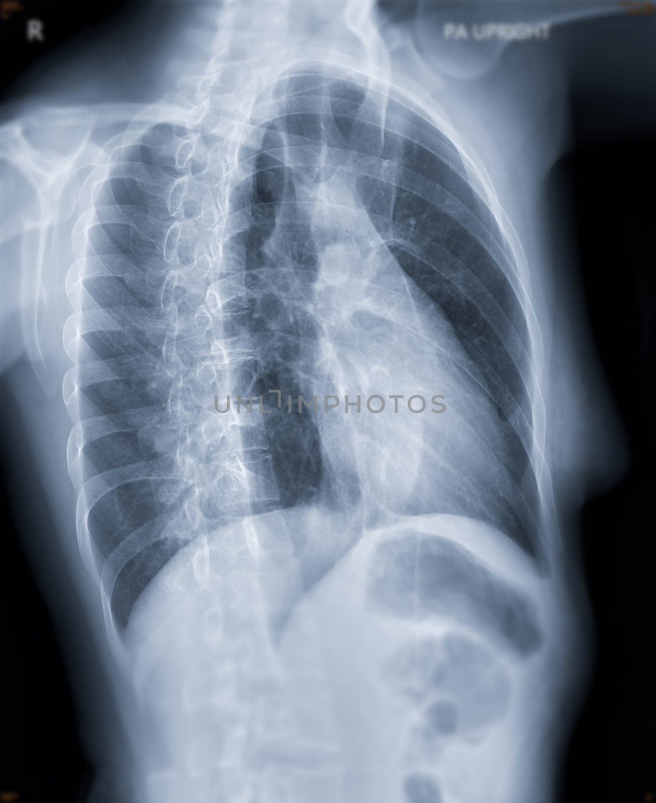 Chest x-ray image oblique view for screening diagnosis TB,tuberculosis and covid-19.