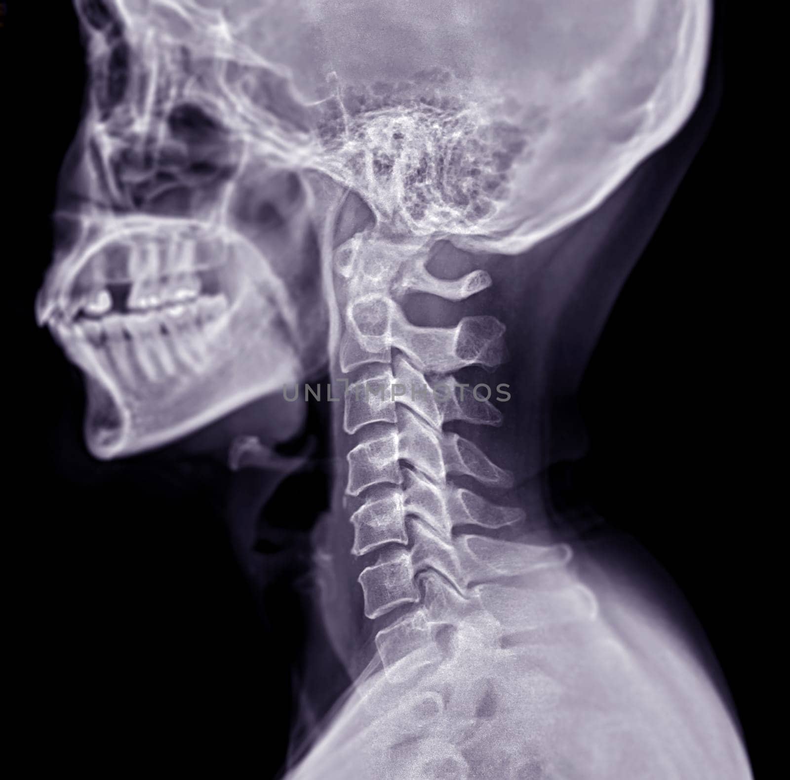 X-ray C-spine or x-ray image of Cervical spine lateral view for diagnostic intervertebral disc herniation and Spondylosis. by samunella