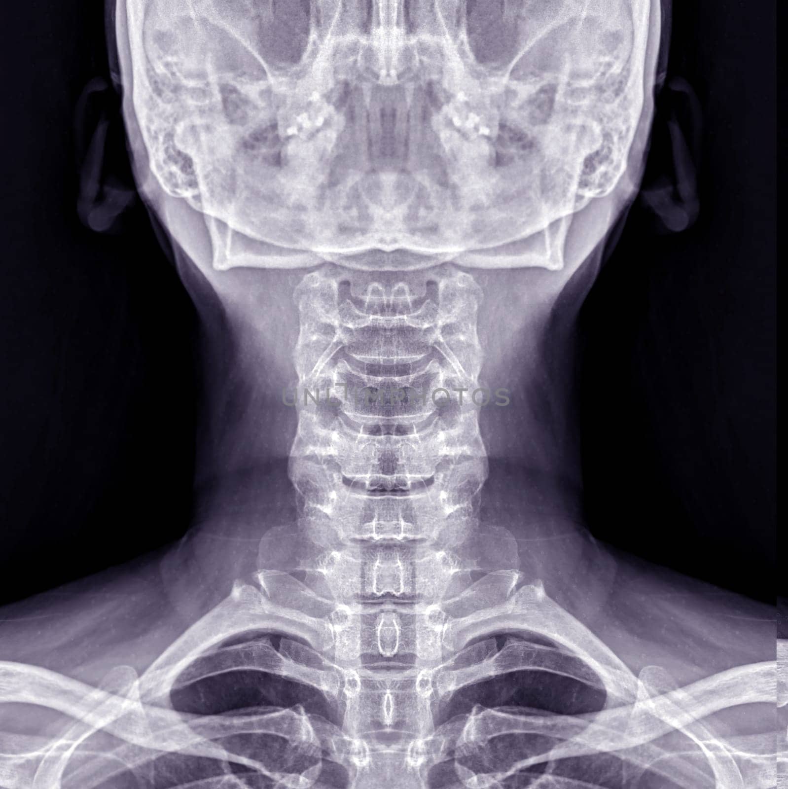 X-ray C-spine or x-ray image of Cervical spine AP view for diagnostic intervertebral disc herniation and Spondylosis. by samunella