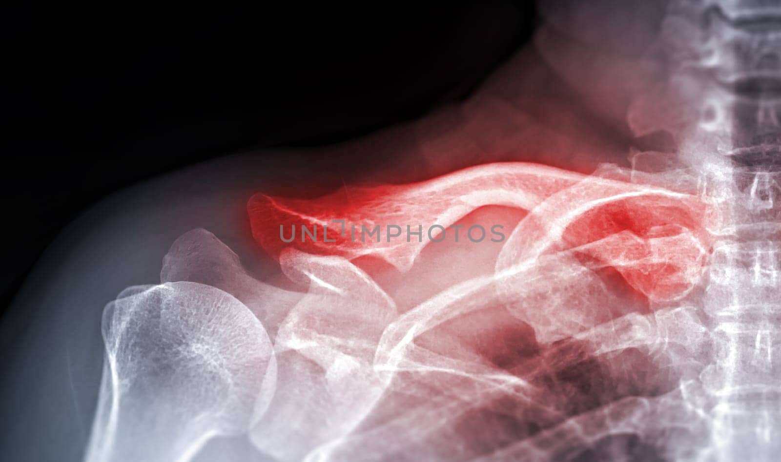 X-ray of Clavicle AP view for diagnosis fracture of Clavicle bone. by samunella