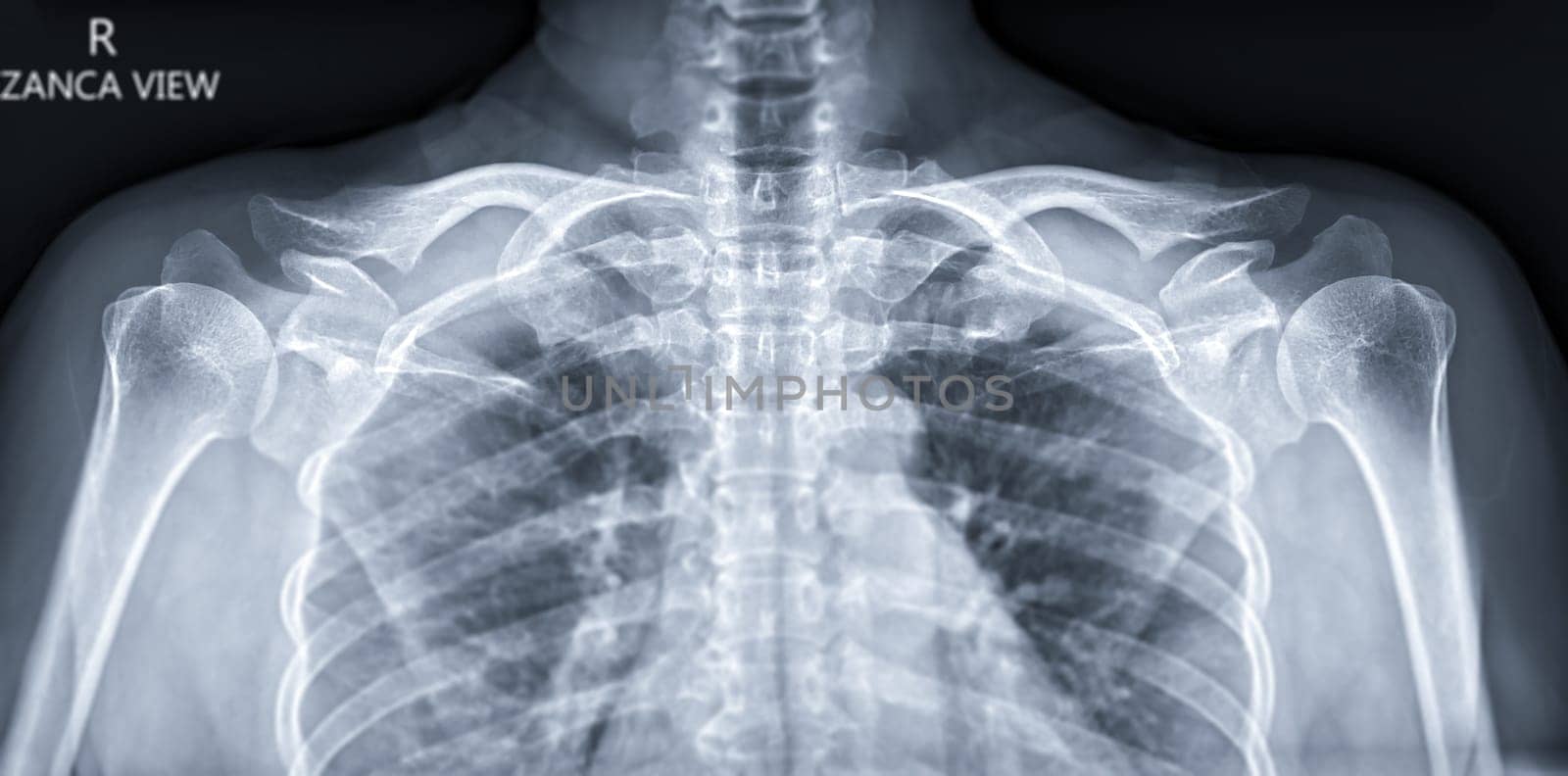 X-ray of both Clavicle Zanca view for diagnosis fracture of Clavicle .
