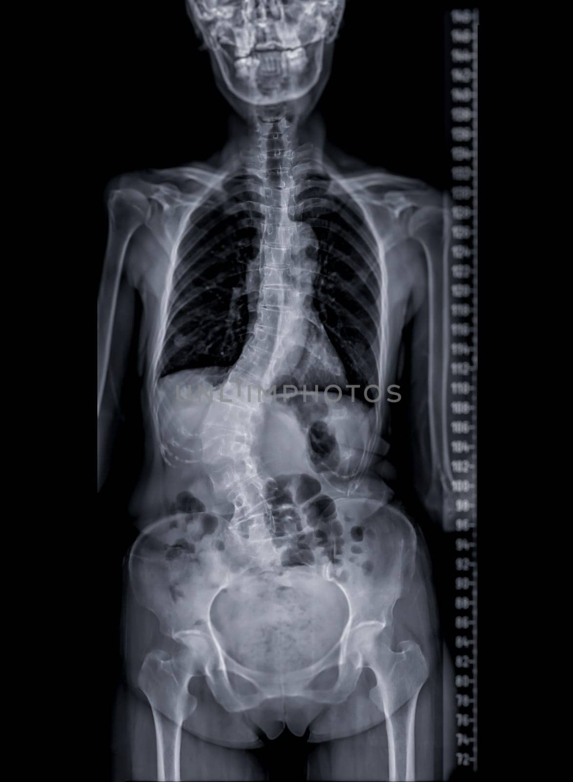 X-ray image of Whole Spine for diagnosis scoliosis of spine.