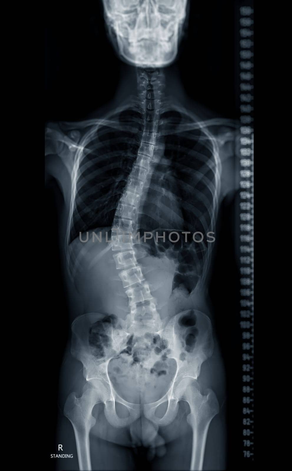 X-ray image of Whole Spine for diagnosis scoliosis of spine. by samunella