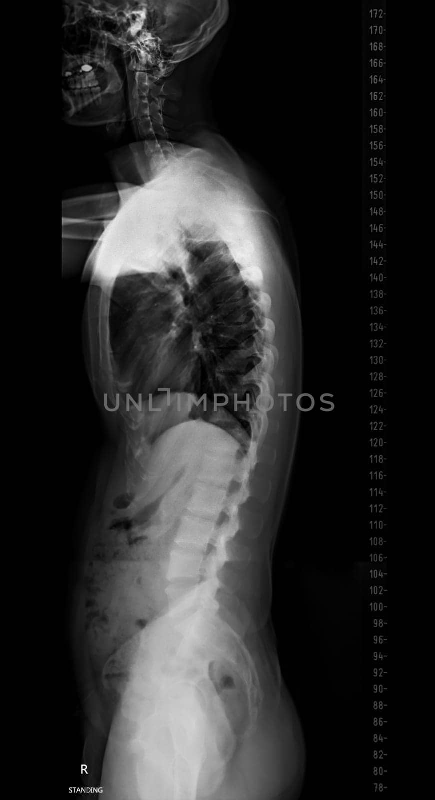 X-ray image of Whole Spine for diagnosis scoliosis of spine.