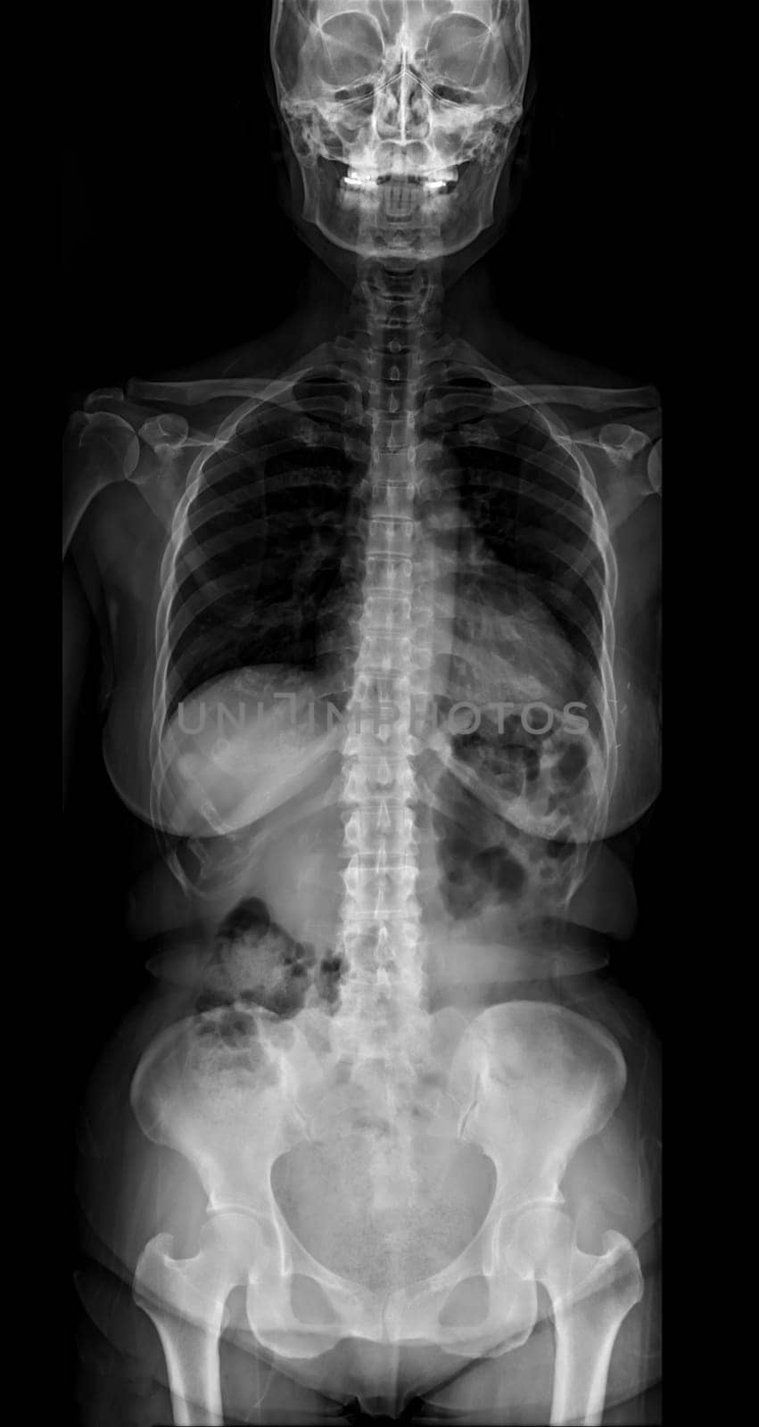 X-ray image of Whole Spine for diagnosis scoliosis of spine.