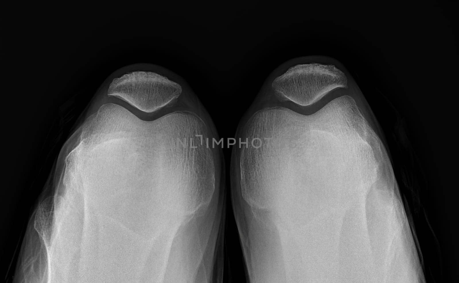 X-ray image of both knee AP view for diagnostic Osteoarthritis or knee fracrure. by samunella