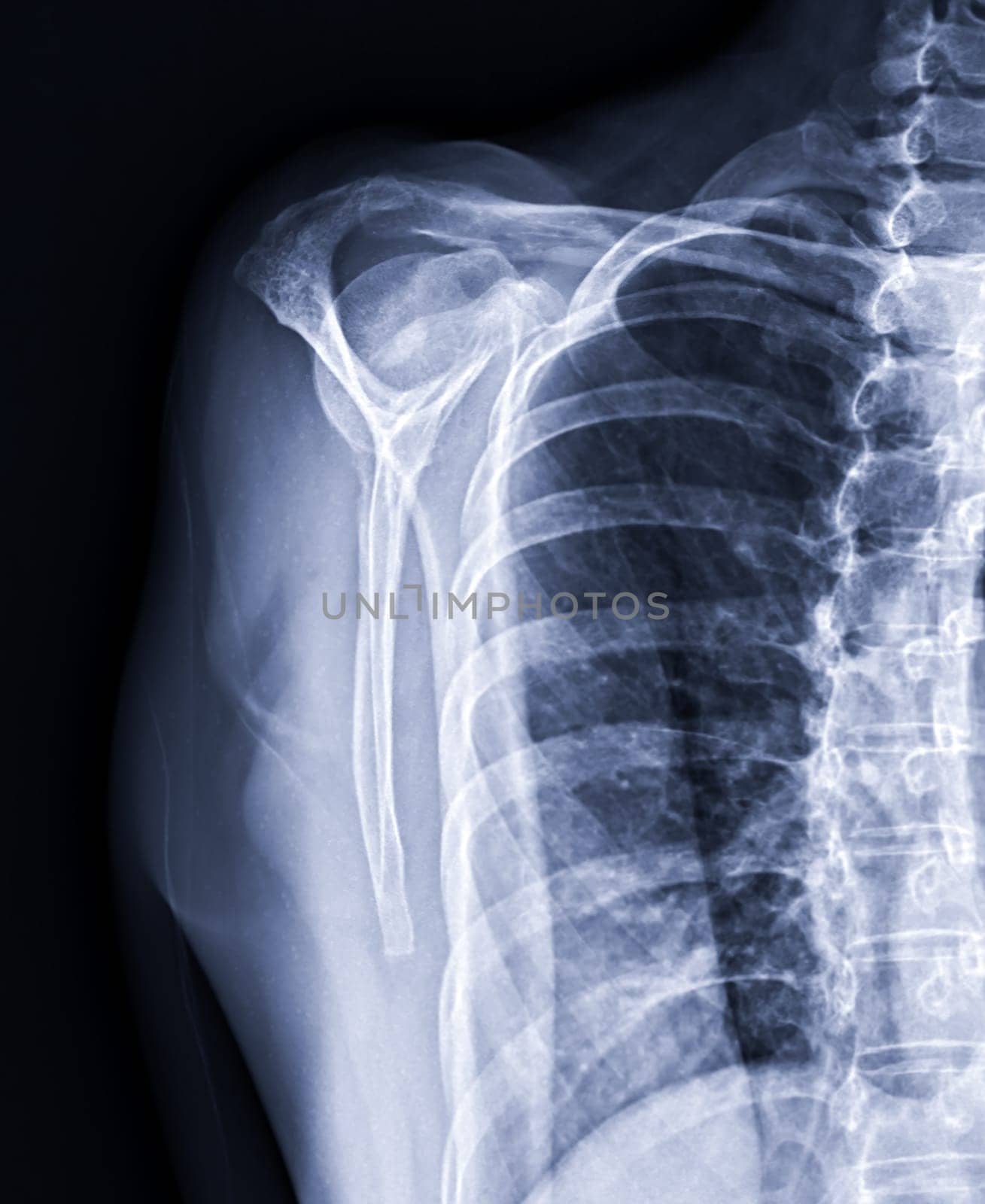 X-ray Shoulder joint shoulder front view for diagnosis fracture of shoulder joint. by samunella