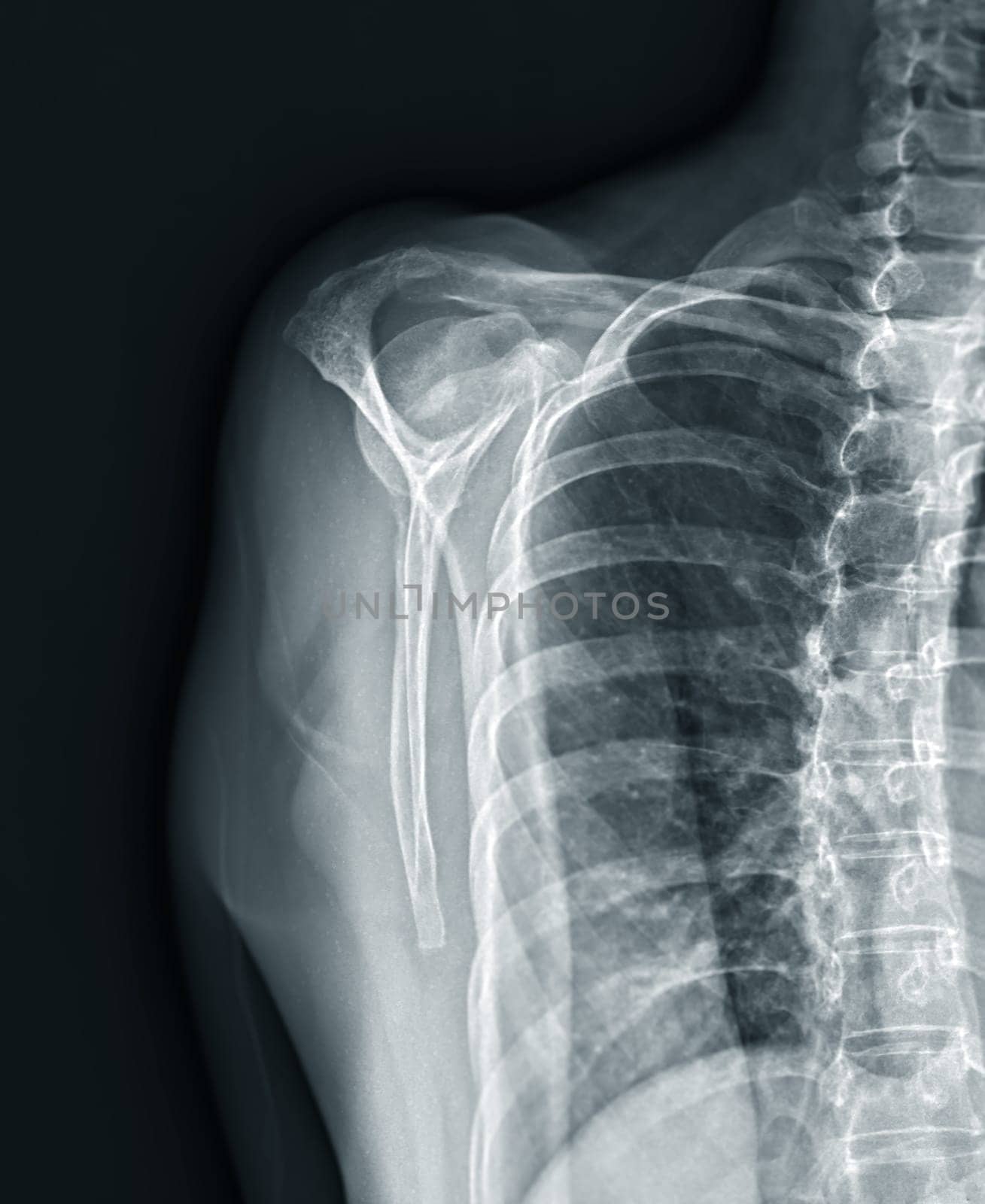 X-ray Shoulder joint shoulder front view for diagnosis fracture of shoulder joint. by samunella