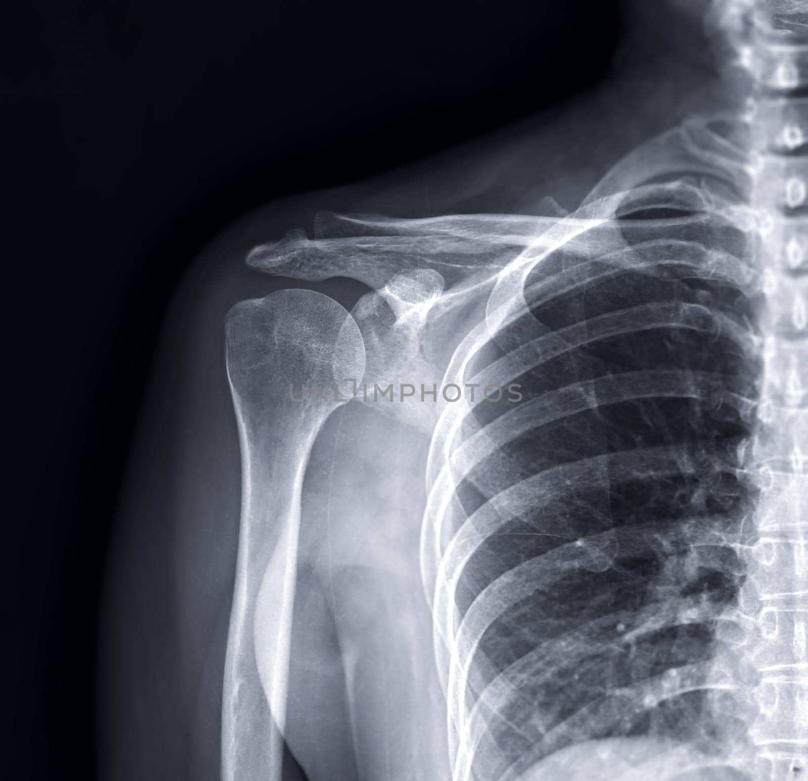 X-ray Shoulder joint shoulder front view for diagnosis fracture of shoulder joint.