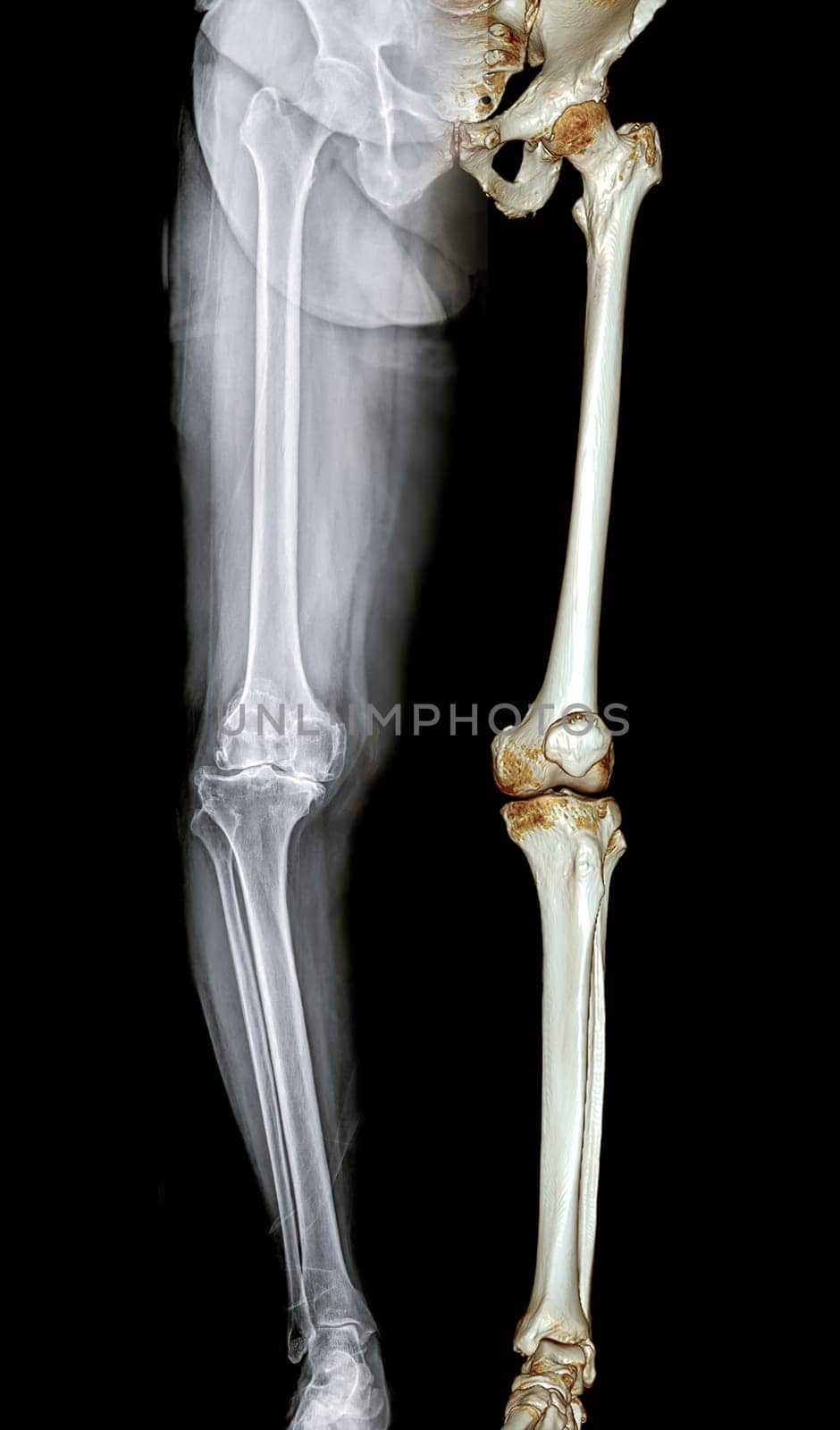 Scanogram is a Full-length standing AP radiograph of both lower extremities including the hip, knee, and ankle. by samunella