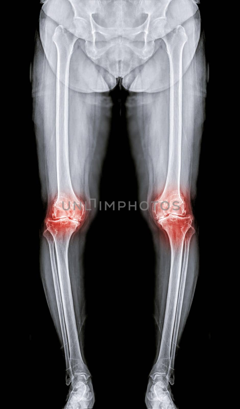 Scanogram is a Full-length standing AP radiograph of both lower extremities including the hip, knee, and ankle. by samunella