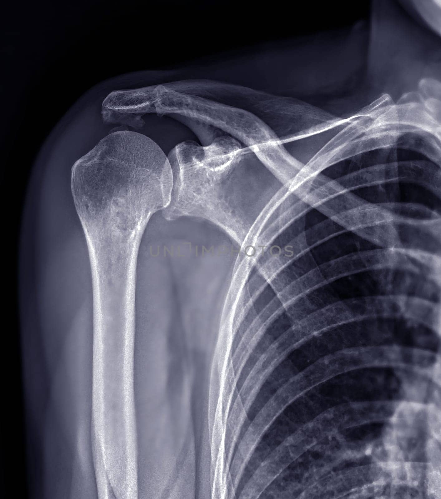 X-ray Shoulder joint shoulder front view for diagnosis fracture of shoulder joint. by samunella