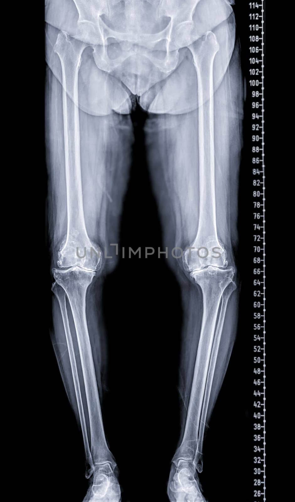 Scanogram is a Full-length standing AP radiograph of both lower extremities including the hip, knee, and ankle. by samunella