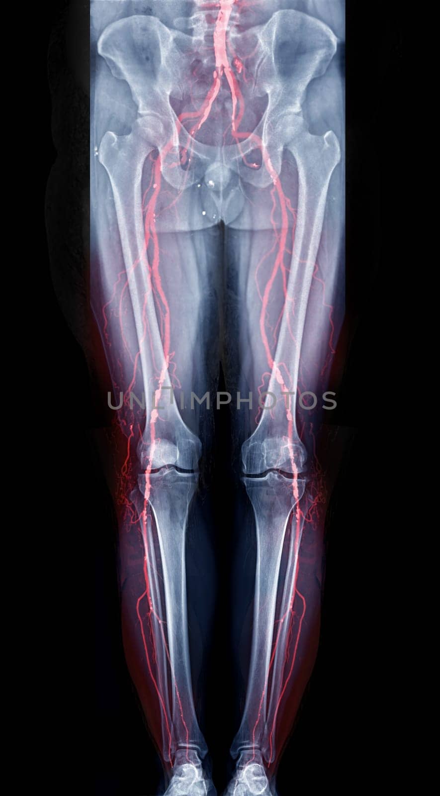 scanogram of lower extremity with Fusion CTA Femoral run off showing bone and vessel of lower limb. by samunella