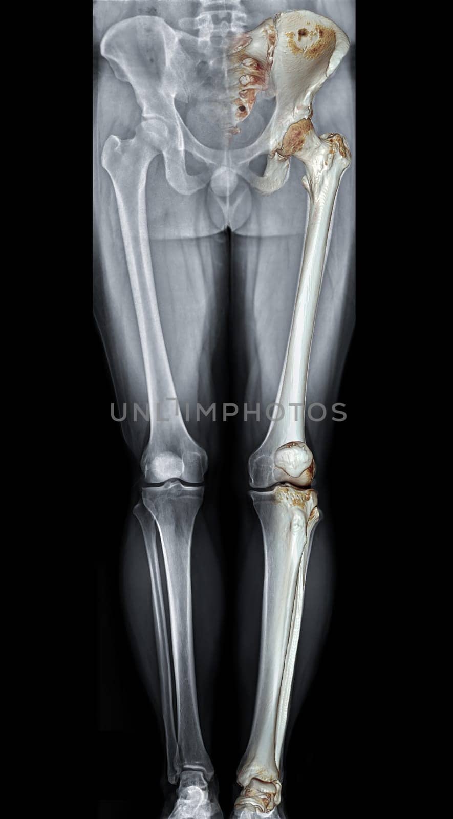 Scanogram is a Full-length standing AP radiograph of both lower extremities including the hip, knee, and ankle with 3D rendering. by samunella