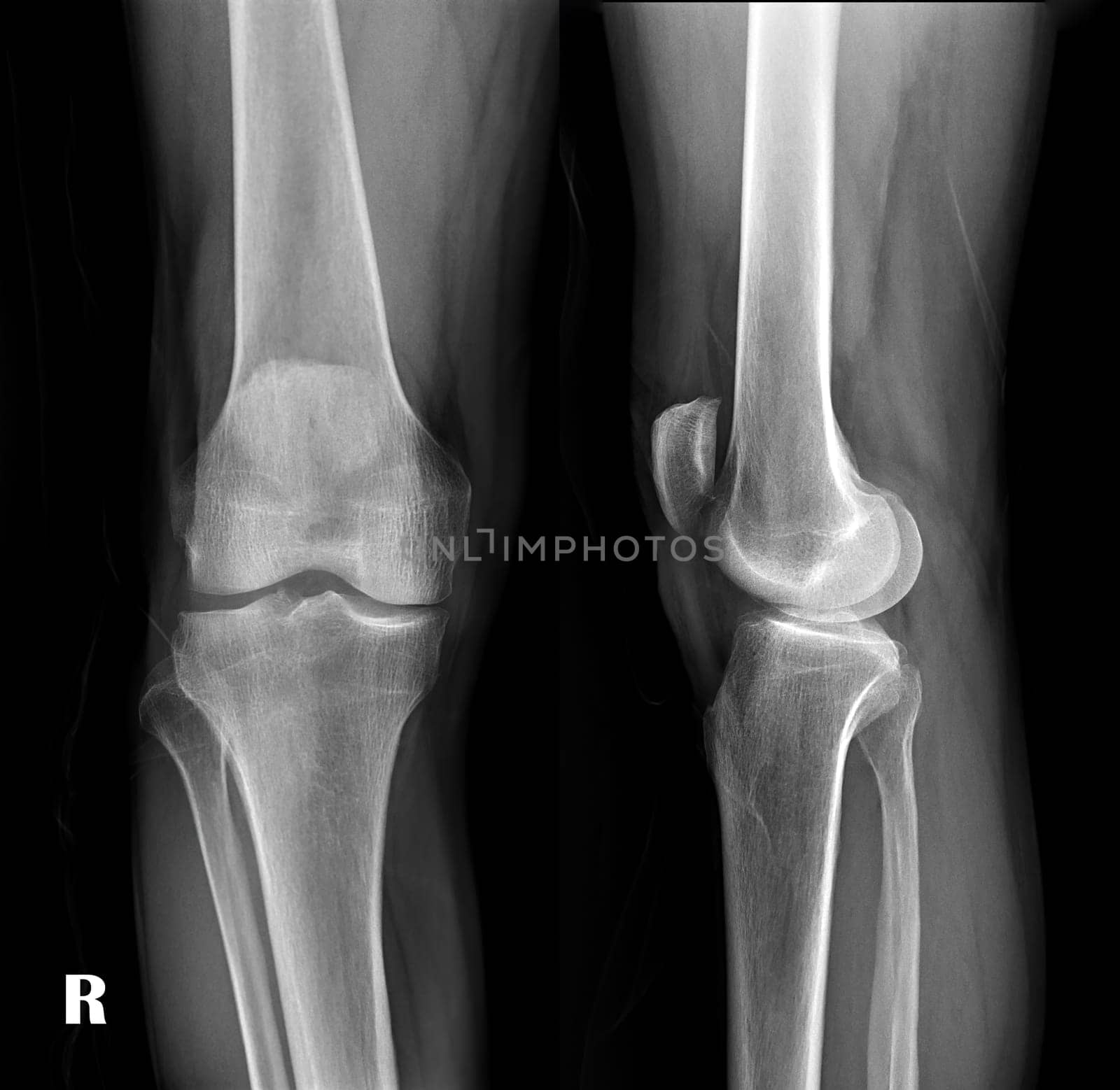 film x-ray both knee joint AP view for diagnosis knee pain from osteoarthritis knee and fracture . by samunella