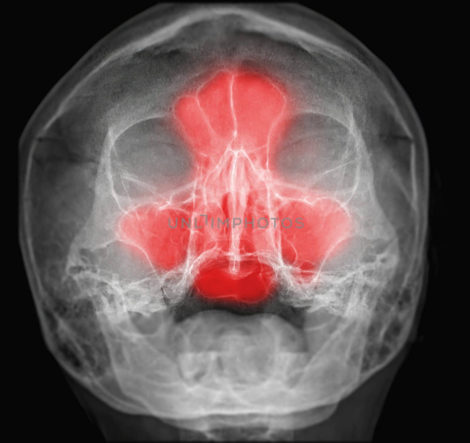 x-ray image of paranasal sinuses for diagnosis sinusitis.