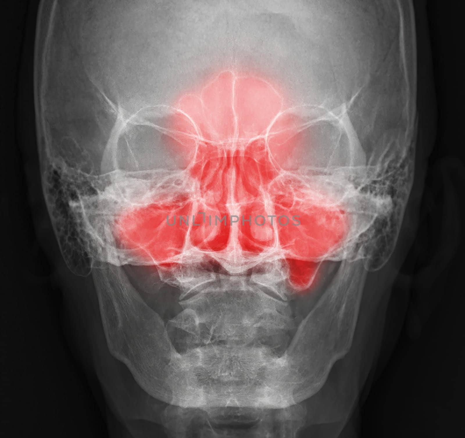 x-ray image of paranasal sinuses for diagnosis sinusitis. by samunella