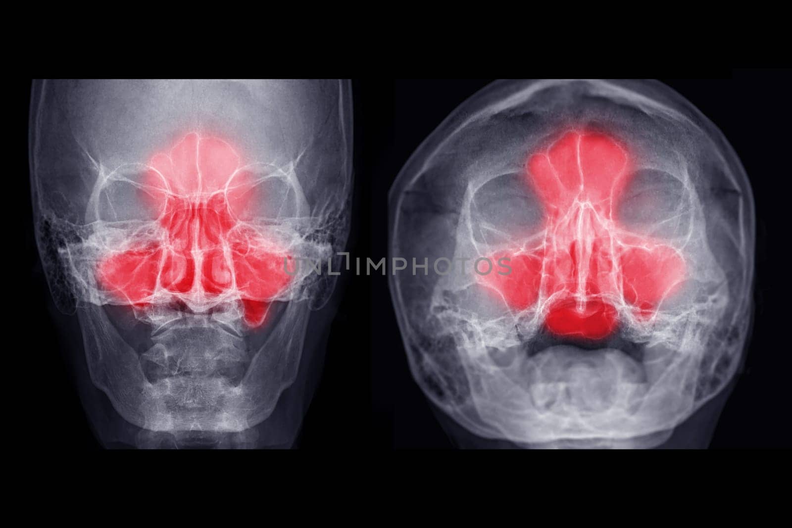 x-ray image of paranasal sinuses Ap and water's view for diagnosis sinusitis. by samunella