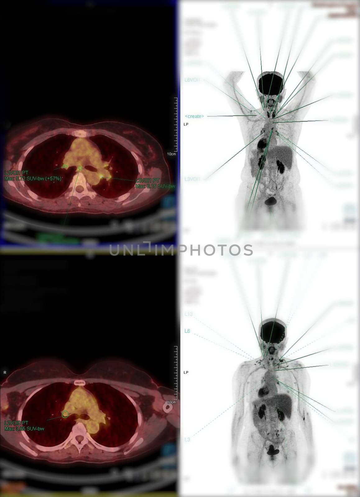 Positron emission tomography (PET) CT scan uses a radioactive drug (tracer) to show both normal and abnormal metabolic activity of Whole human body for detect cancer recurrence after surgery .