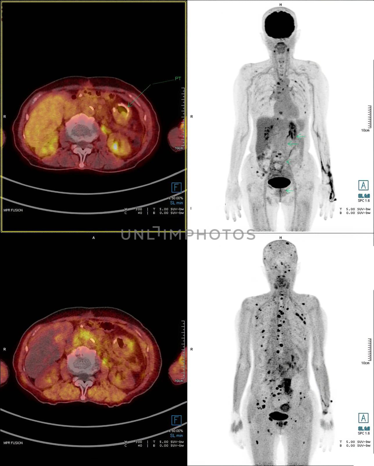 Positron emission tomography (PET) CT scan uses a radioactive drug (tracer) to show both normal and abnormal metabolic activity of Whole human body for detect cancer recurrence after surgery .