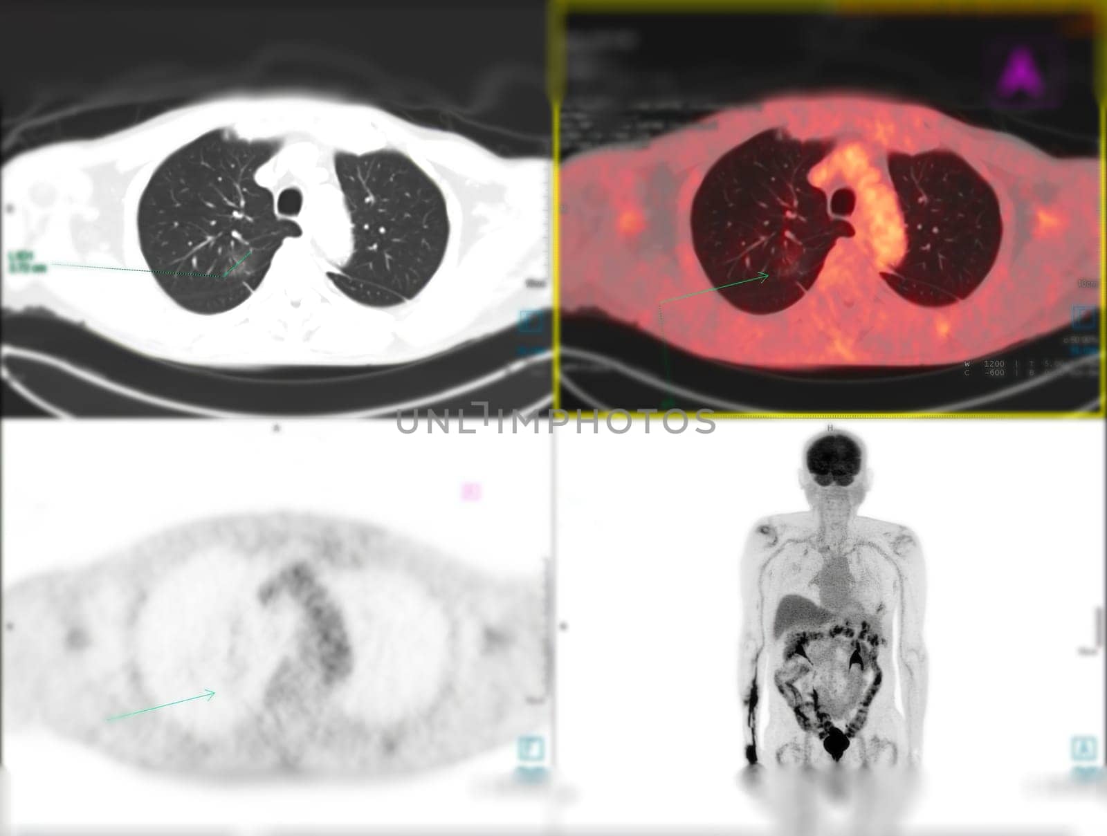 Positron emission tomography (PET) CT scan uses a radioactive drug (tracer) to show both normal and abnormal metabolic activity of Whole human body for detect cancer recurrence after surgery .