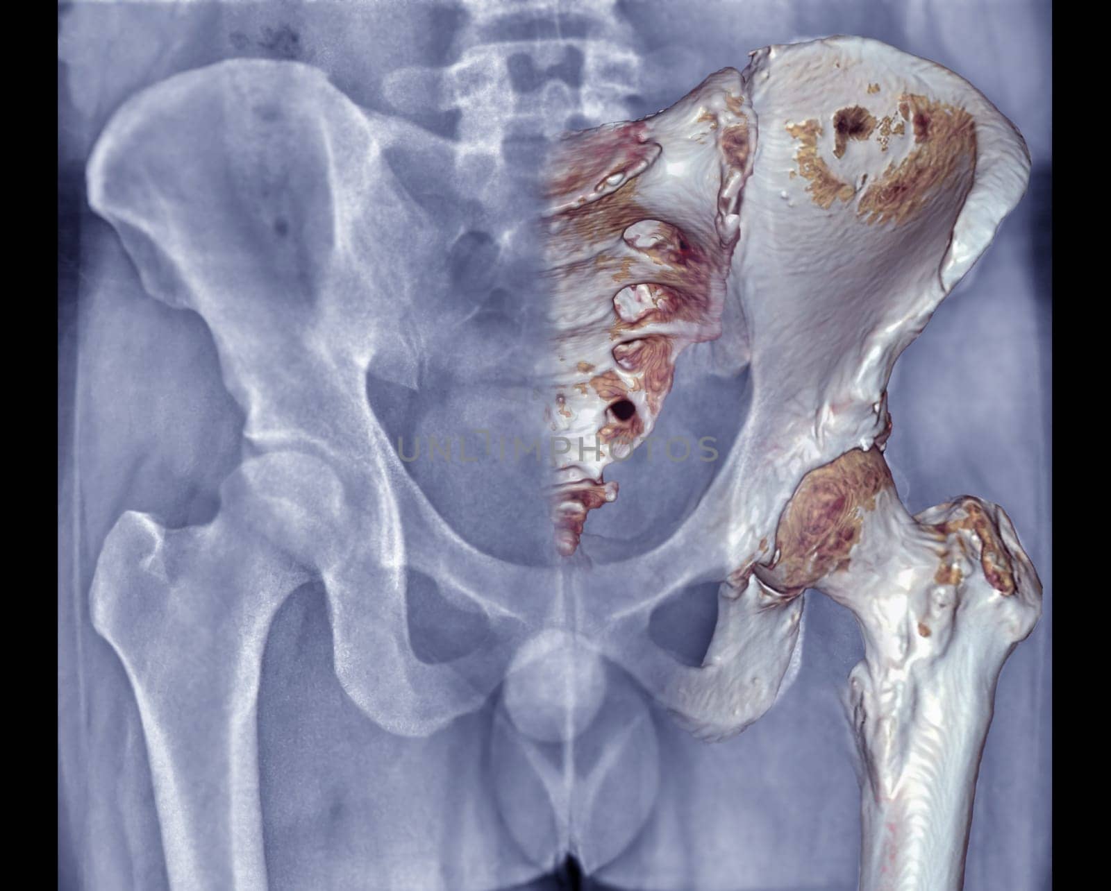 Xray Pelvic Bone ap view with fusion 3D rendering .