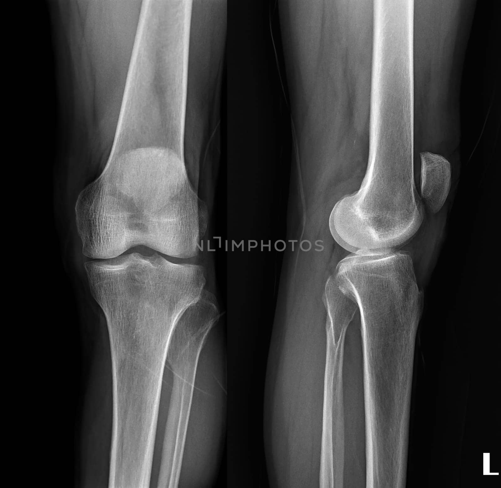 film x-ray both knee joint AP view for diagnosis knee pain from osteoarthritis knee and fracture .