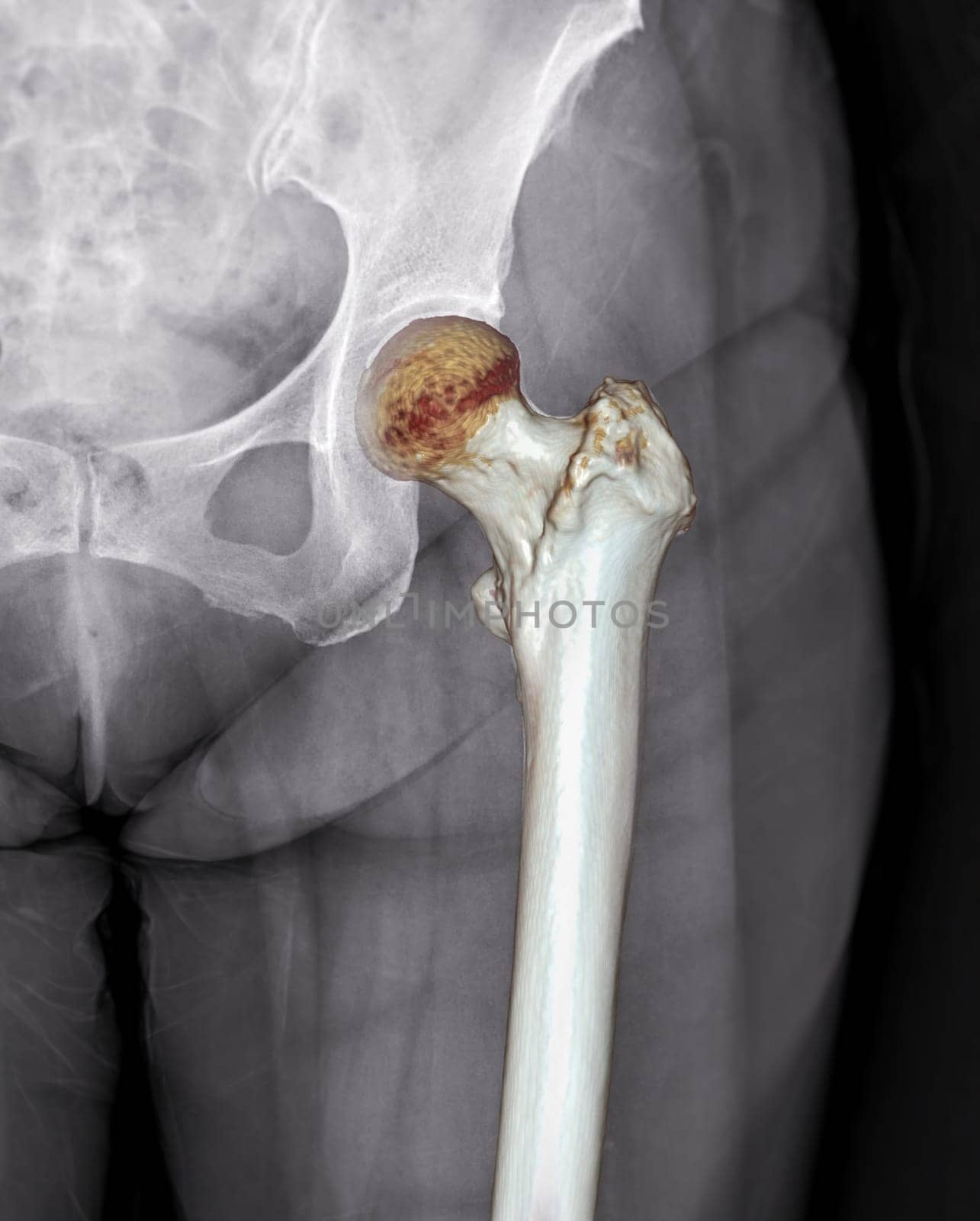 X-ray of Left hip joint front view with 3d rendering of left femur .