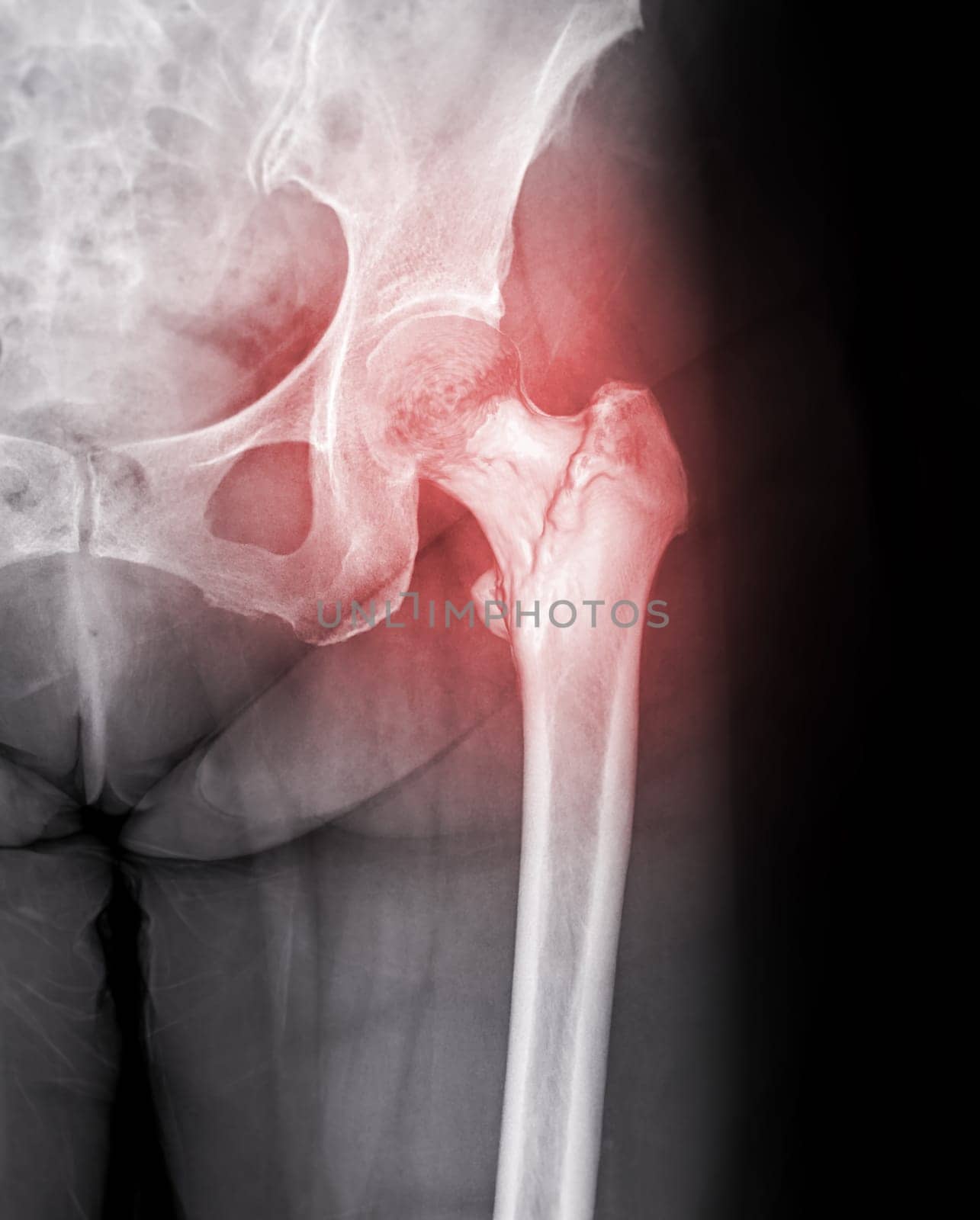 X-ray of Left hip joint front view.