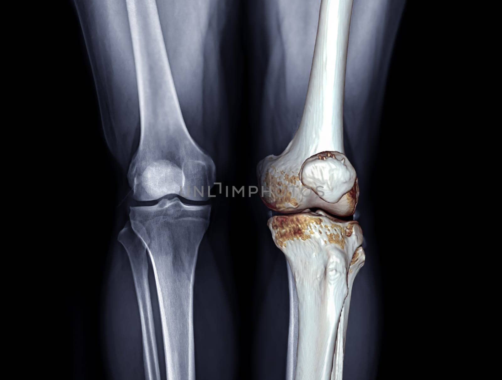 X-ray image of both knee AP view for diagnostic Osteoarthritis or knee fracrure.