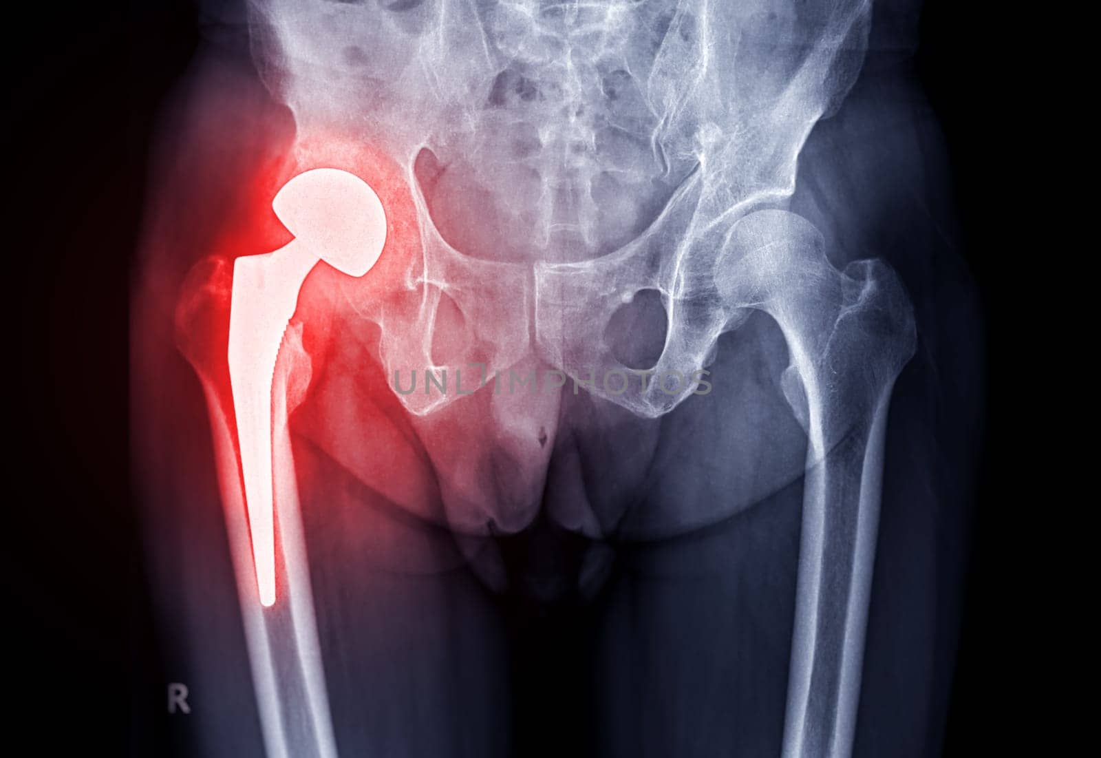 x-ray Both hip ap view showing Right hip replacement or hip prosthesis made from titanium. by samunella