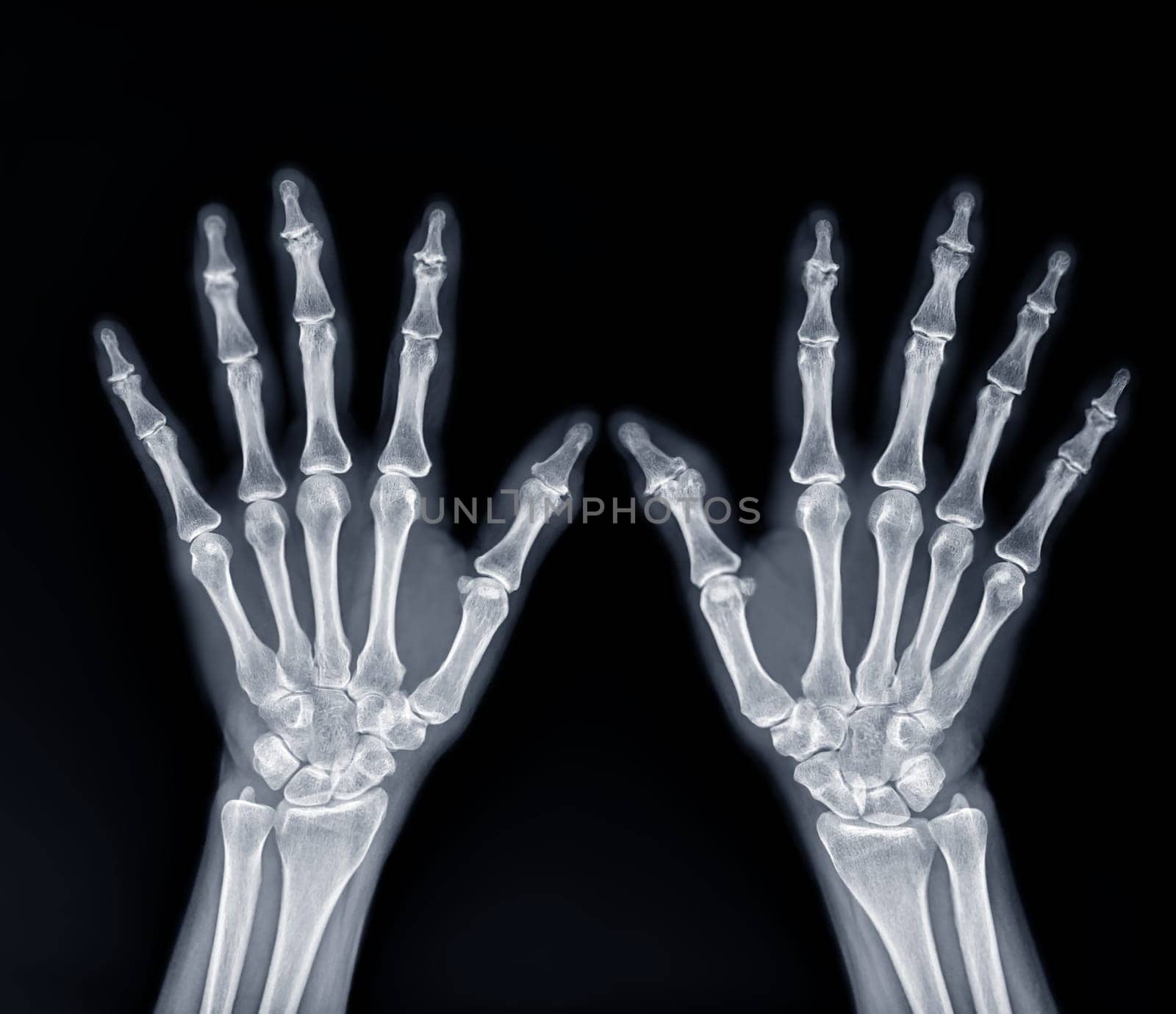 Film x-ray both hand AP view show human's hands isolated on black background .