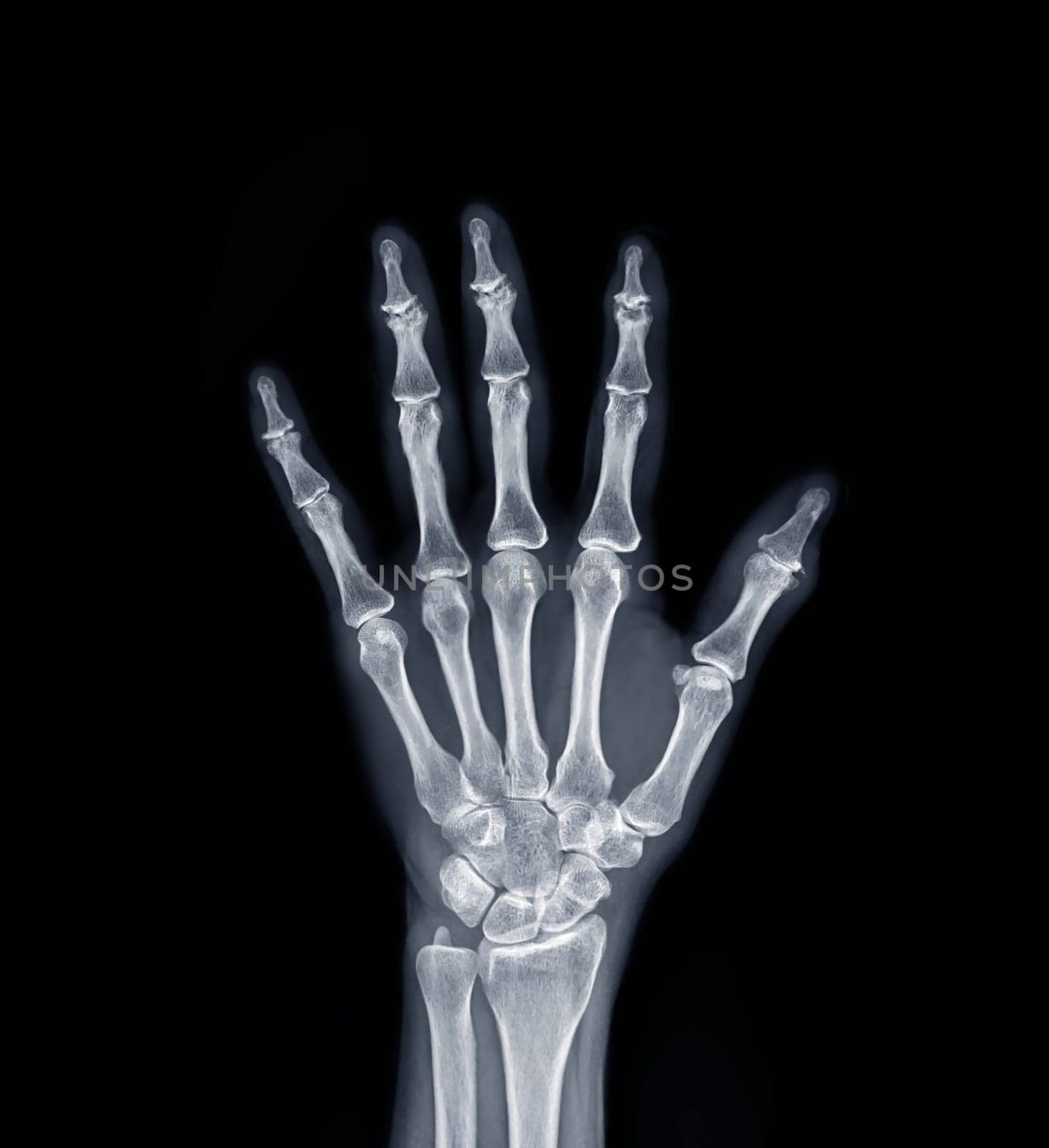 Film x-ray Left Hand AP view show human's hands isolated on black background .