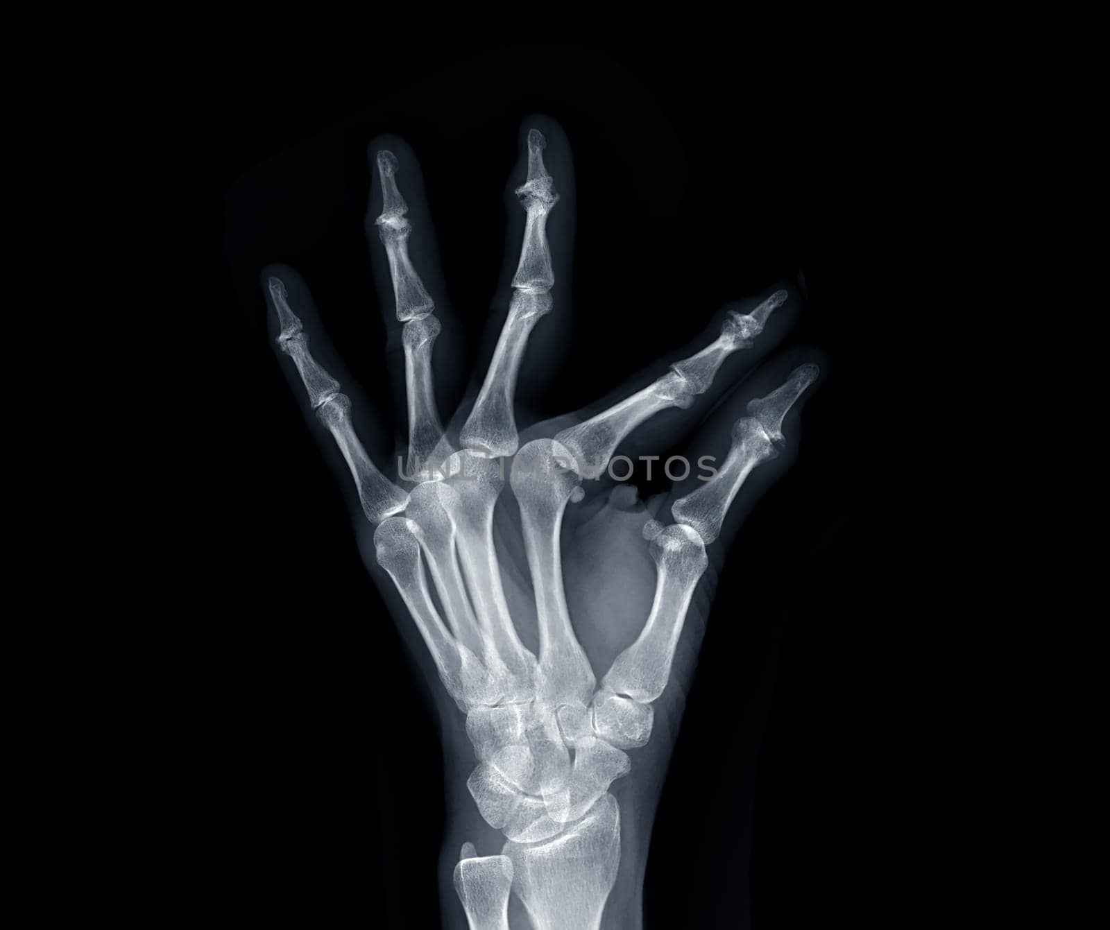 Film x-ray both hand AP view show human's hands isolated on black background .