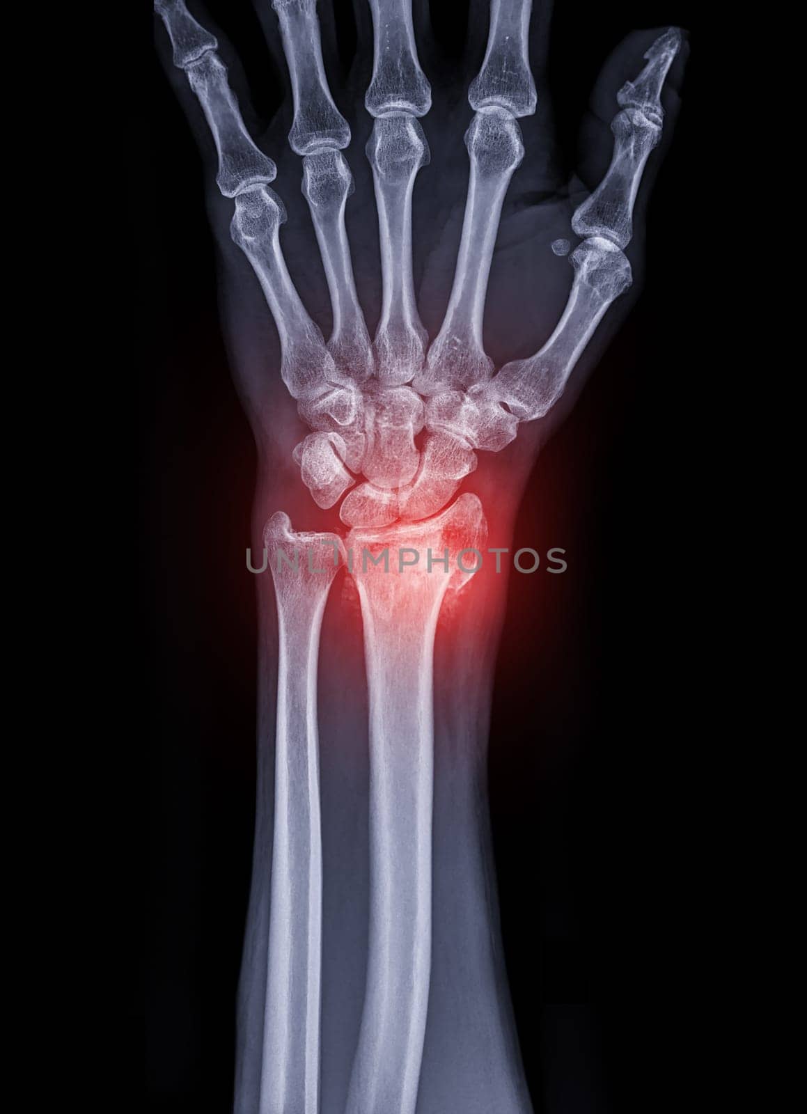 Film x-ray Wrist joint showing fracture of ulnar bone isolated on black background .