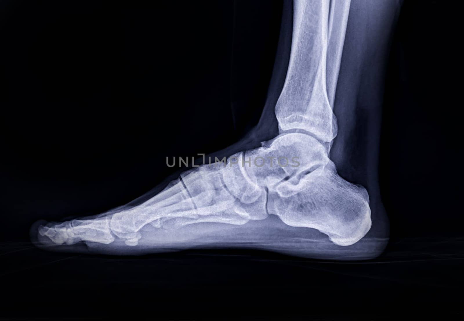 Foot x-ray image Lateral view isolated on black background.