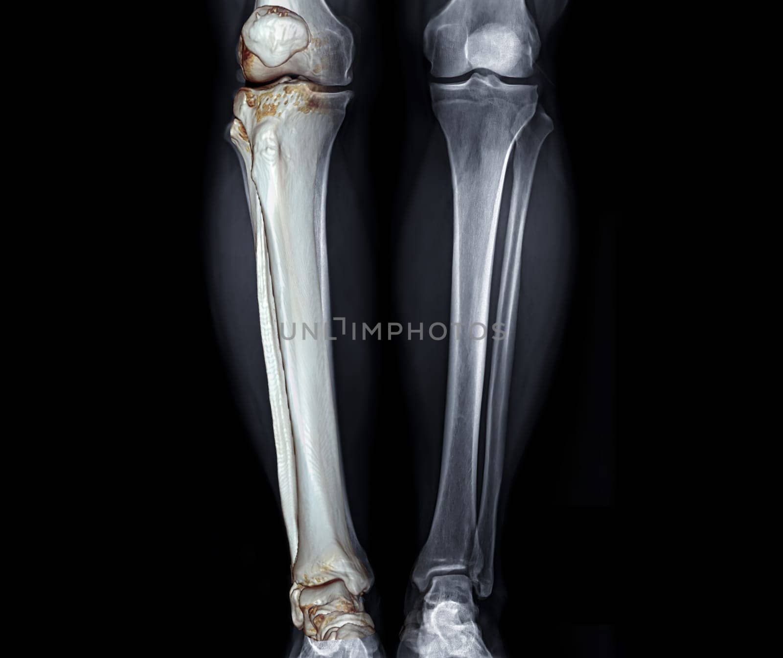 X-ray image of both Leg AP view with 3D leg for diagnostic knee fracrure. by samunella