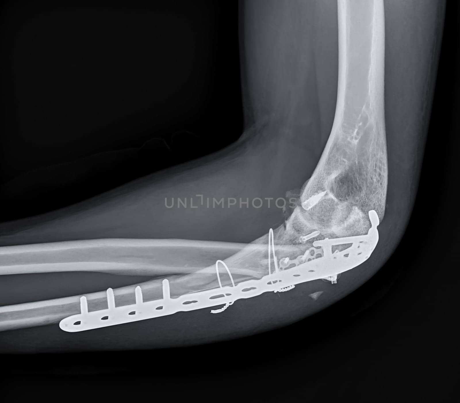 X-ray of Elbow showing internal fixation of the elbow joint.